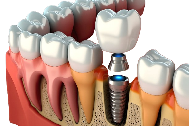 Dental Implants